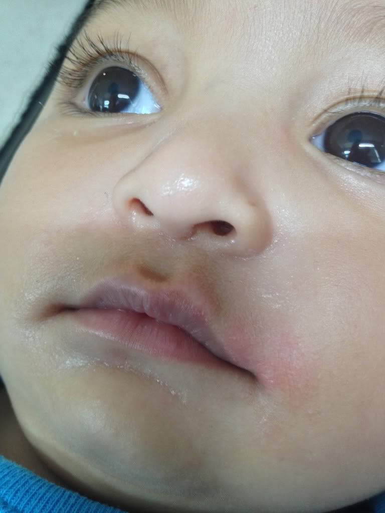 Help Pacifier rashes or eczema flare up? Pic included. BabyCenter
