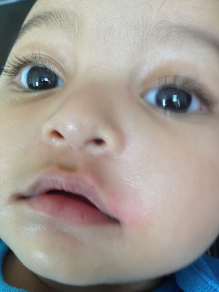 Help Pacifier rashes or eczema flare up? Pic included. BabyCenter